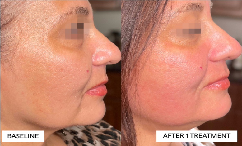 before and after photos of trilift treatment, side view