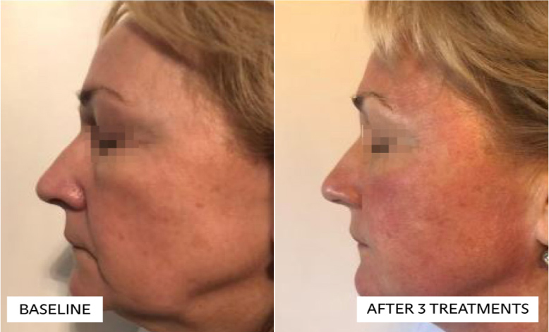before and after photos of facelift like treatment