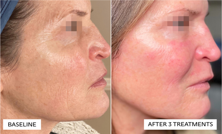 before and after photos of facelift like treatment, side view
