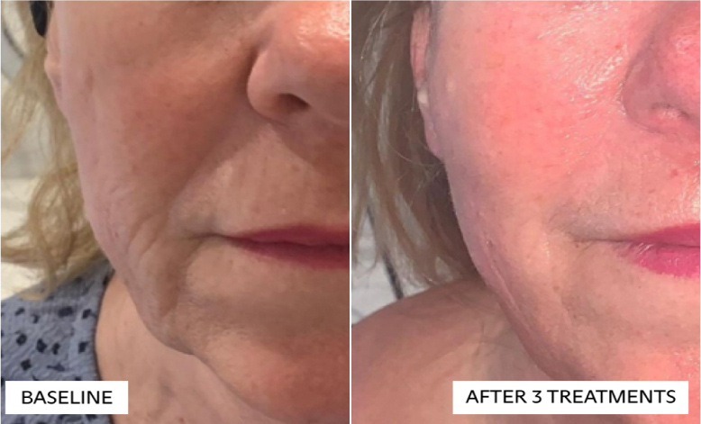 trilift facelift like treatment - before and after pictures